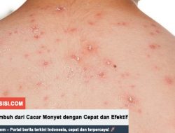 5 Cara Sembuh dari Cacar Monyet dengan Cepat dan Efektif