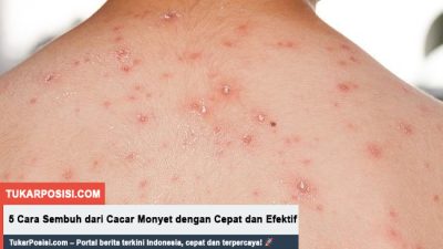 5 Cara Sembuh dari Cacar Monyet dengan Cepat dan Efektif