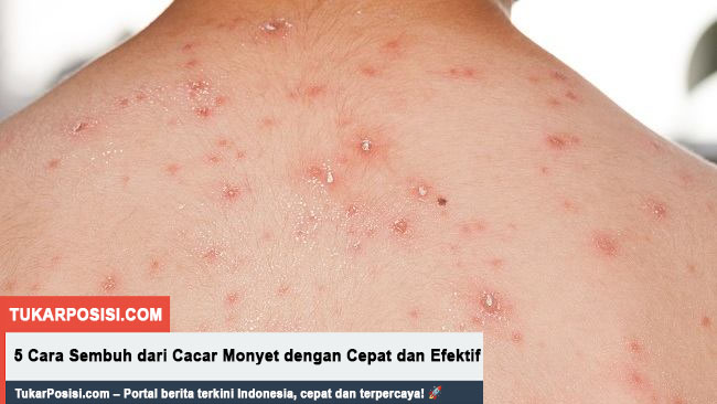 5 Cara Sembuh dari Cacar Monyet dengan Cepat dan Efektif